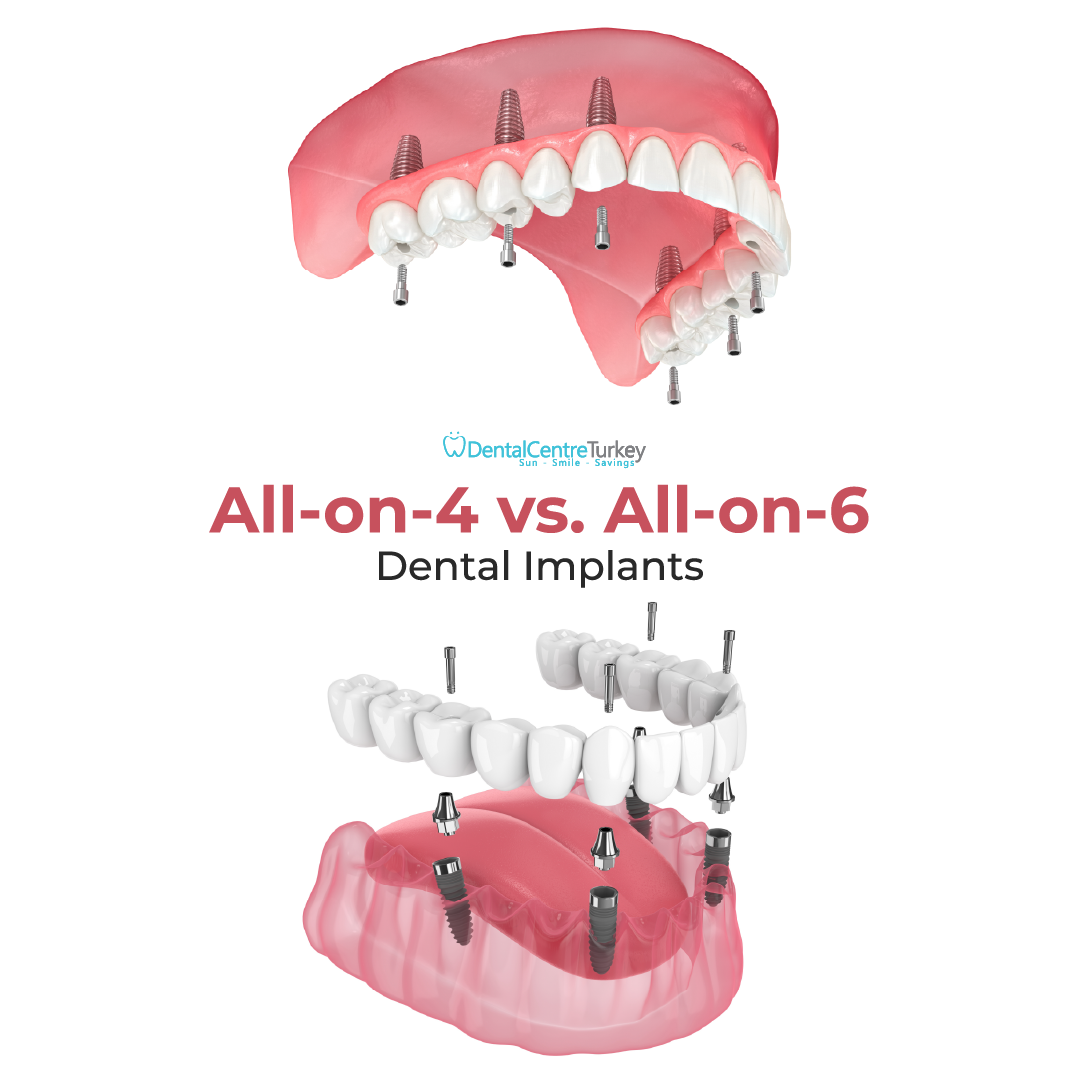 dct allon4 allon6 dentalcentreturkey