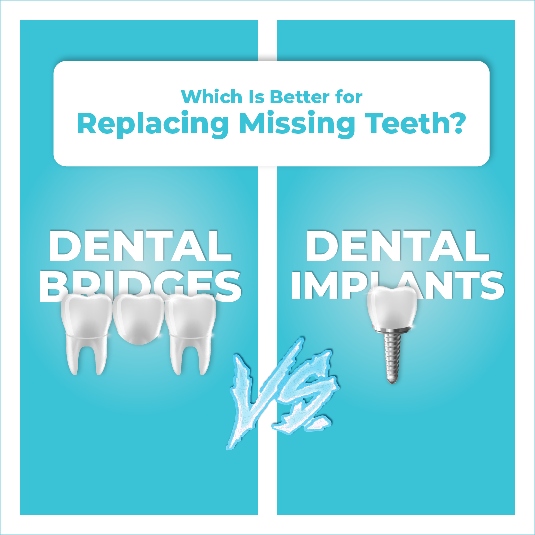 https://dentalcentreturkey-web-assets.s3.eu-west-2.amazonaws.com/images/contents/blog/which-is-better-for-replacing-missing-teeth-dental-bridges-vs.-implants-explained.webp