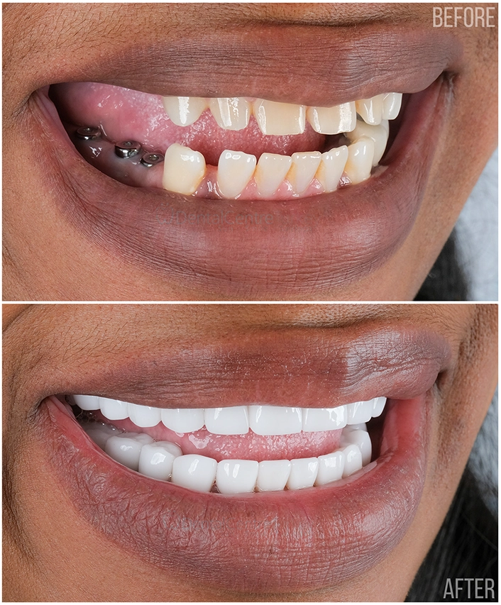 ddental centre turkey dental implant antalya fethiye